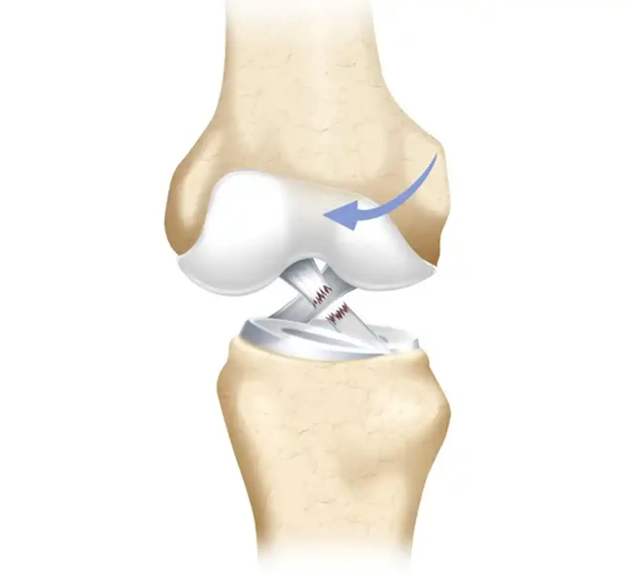 Knee Ligament Injuries