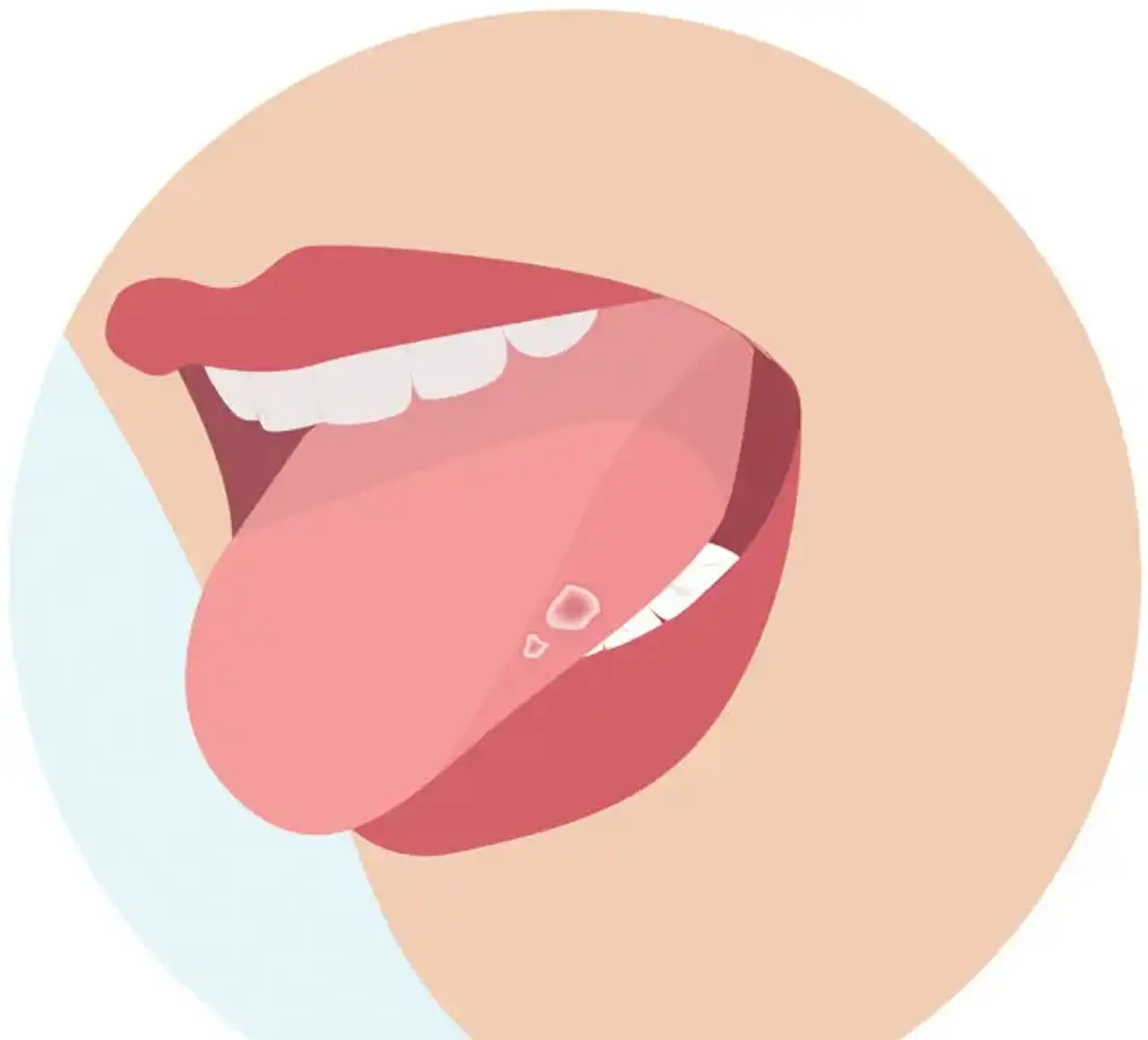 Canker sore on tongue