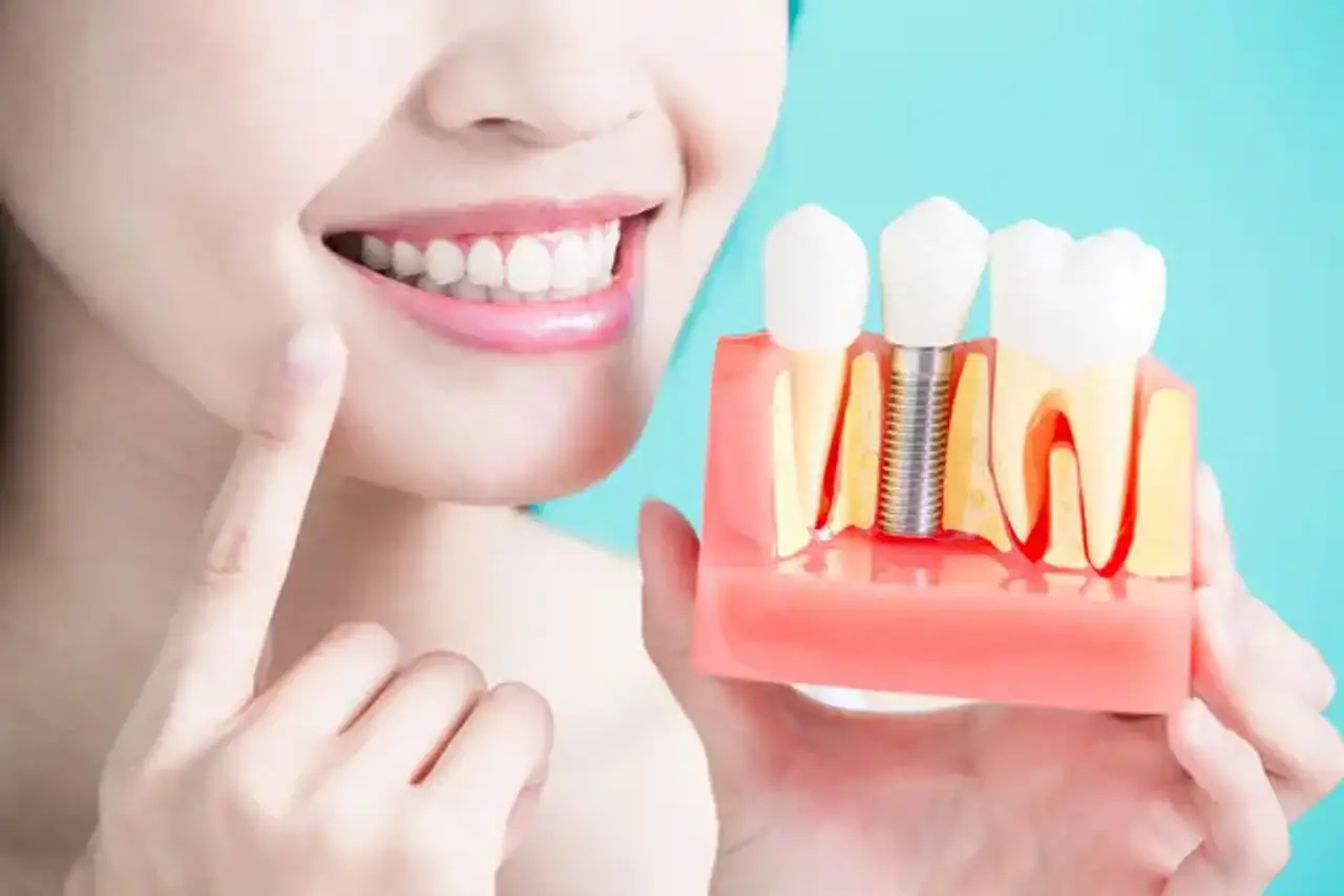 Informazioni sull'impianto dentale
