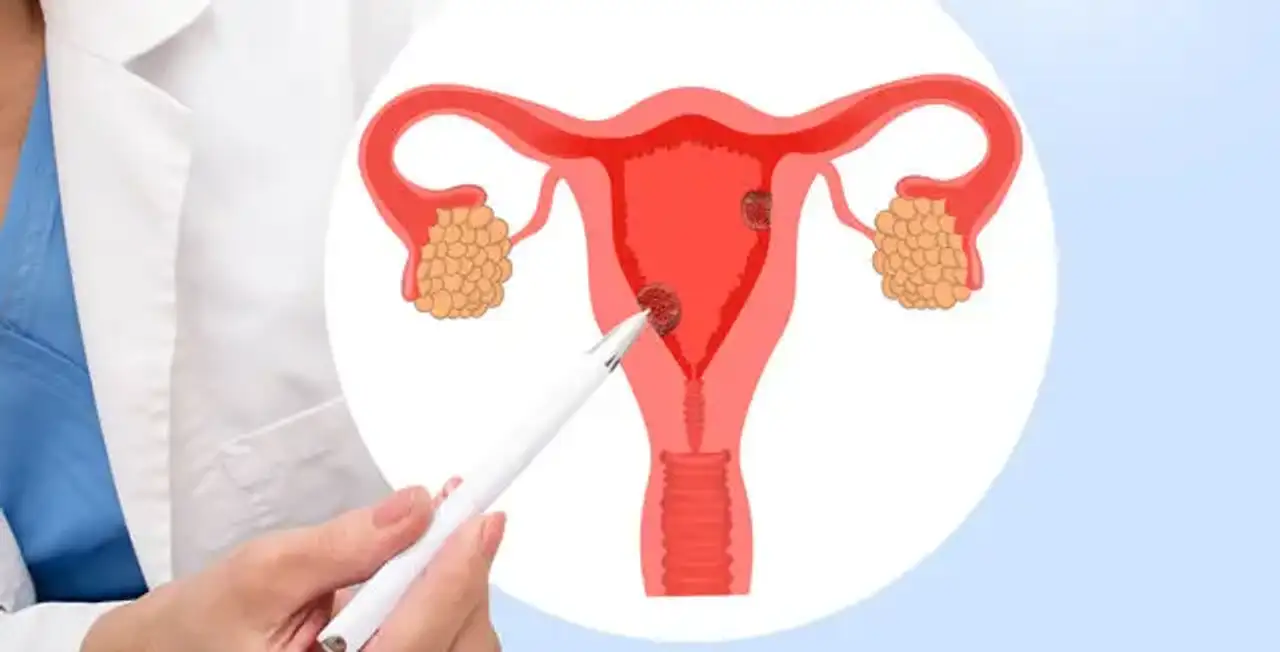 Endometrial Cancer 