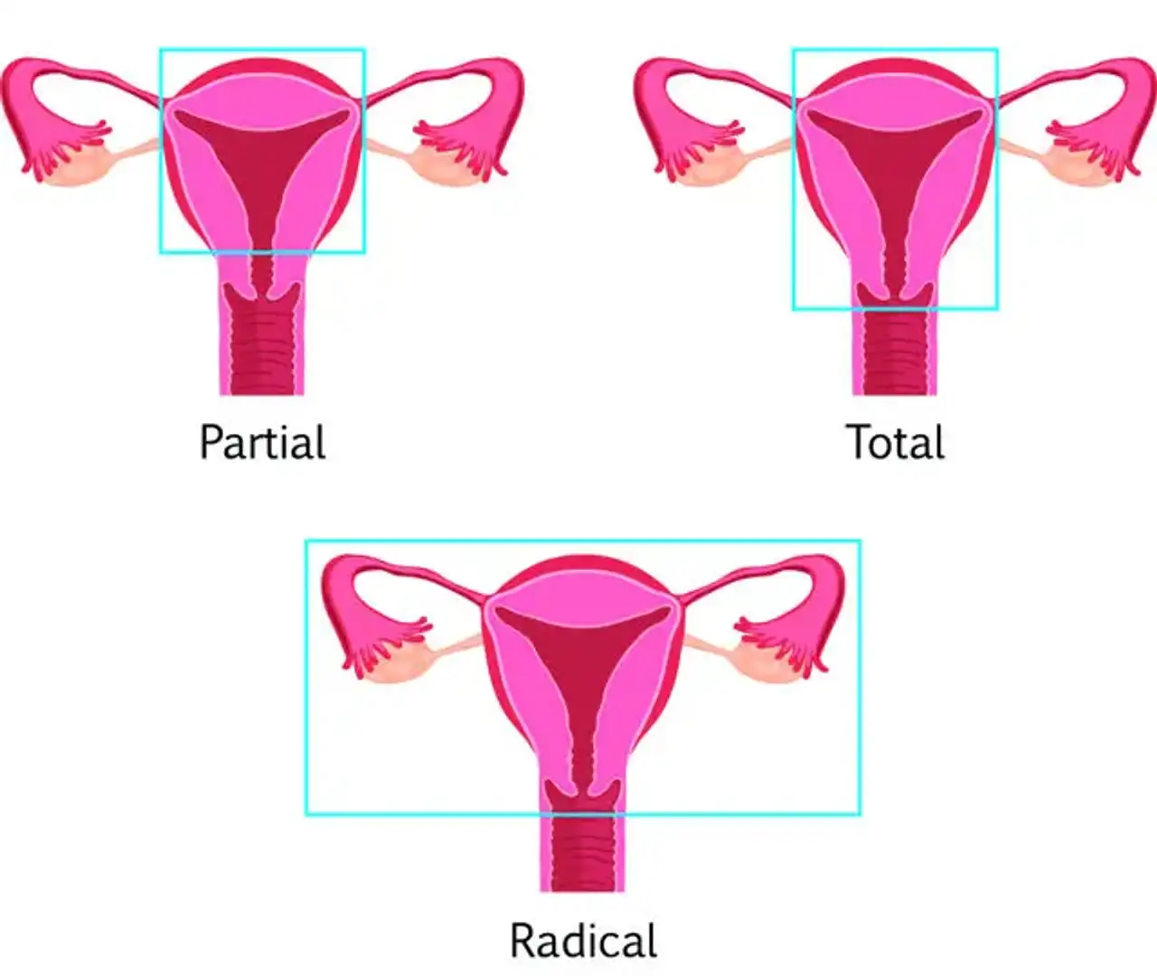 Types of Hysterectomy 