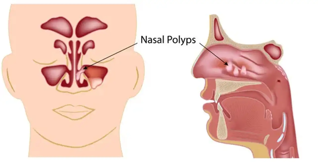 Nasal polyps (NP)