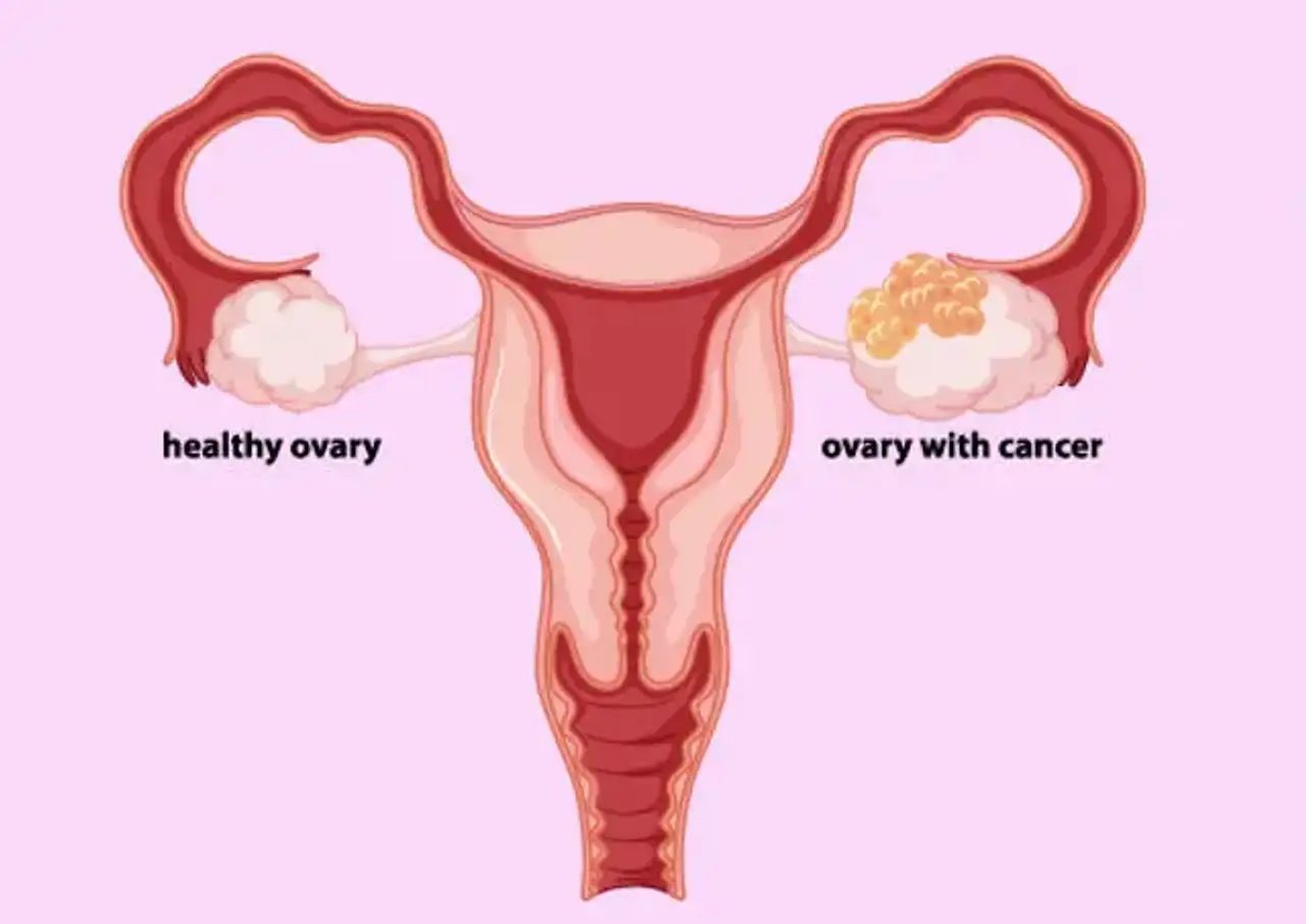 Fatti sul cancro ovarico