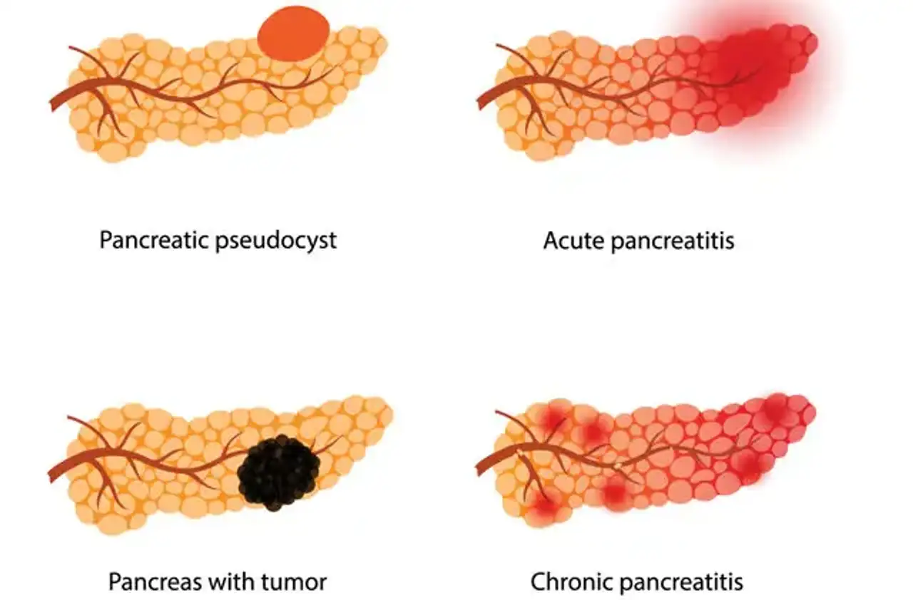 Pancreas disease