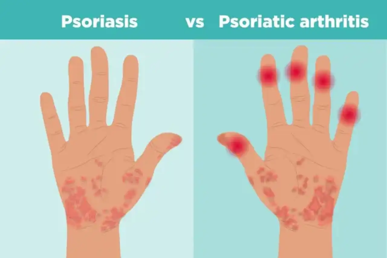 Psoriasis Arthritis