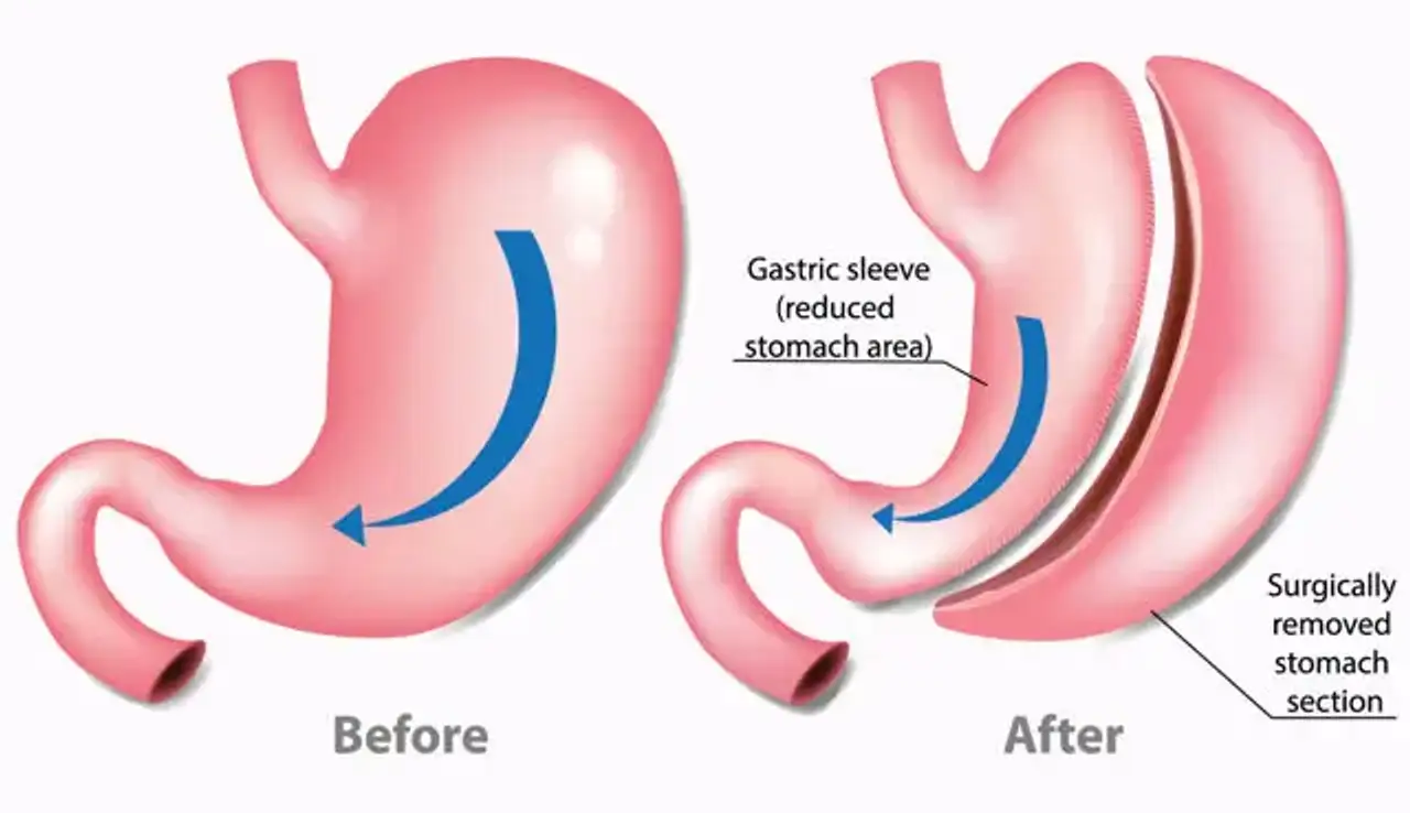 Sleeve Gastrectomy 