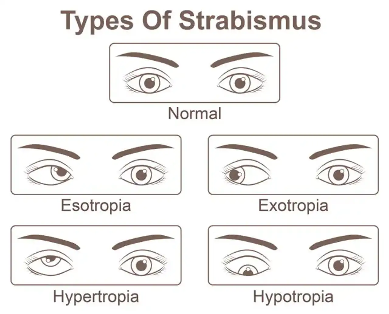 Categories of Strabismus 