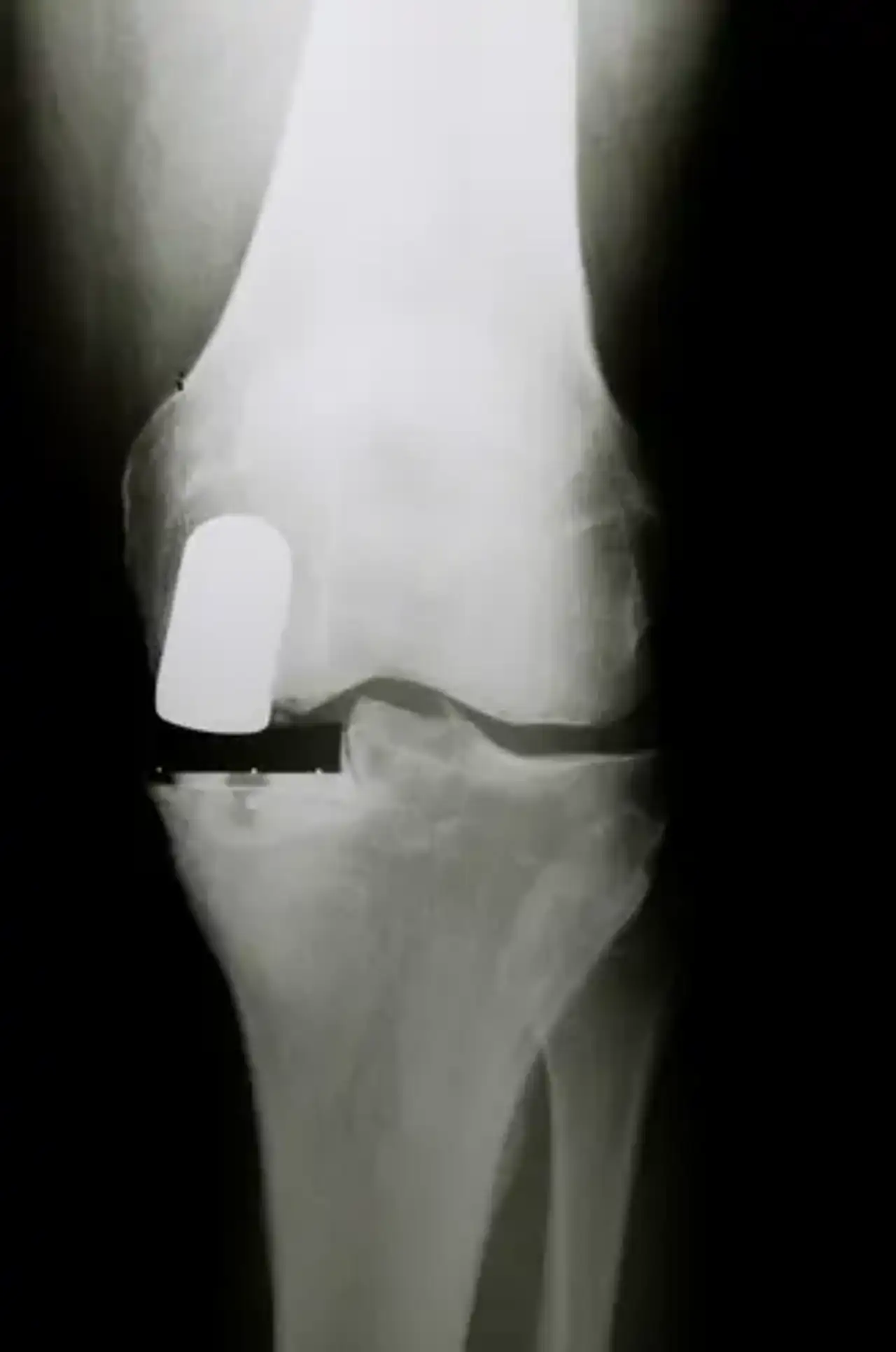 Partial Knee Replacement (PKR)
