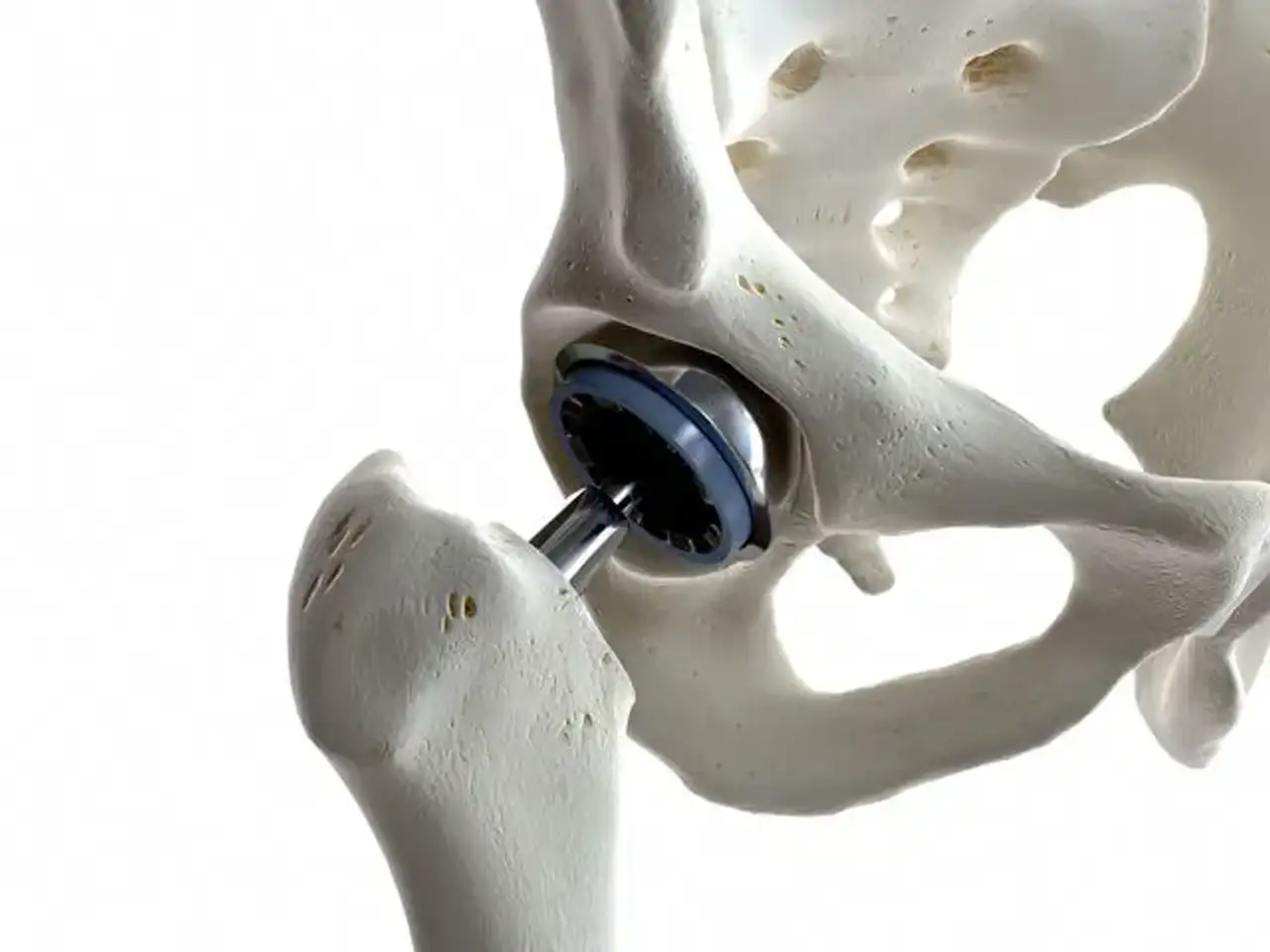 3D PSI Arthroplasty