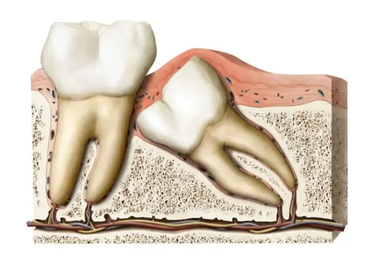 extração dos dentes do siso