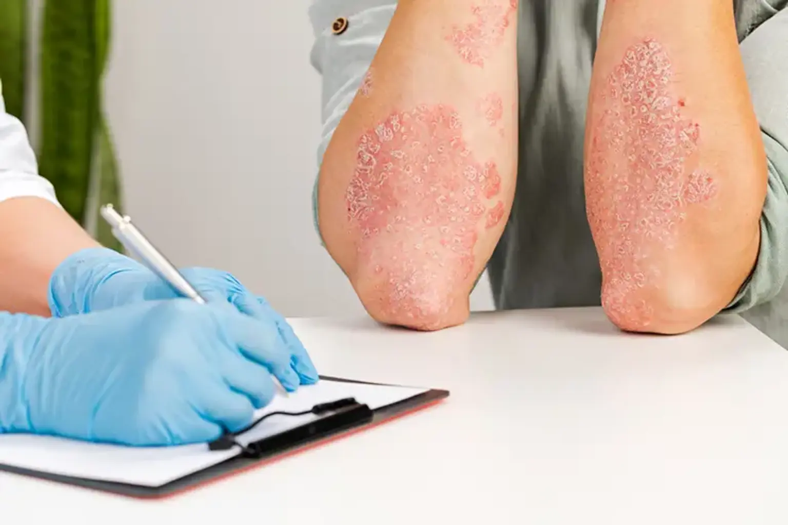 what-is-atopic-dermatitis