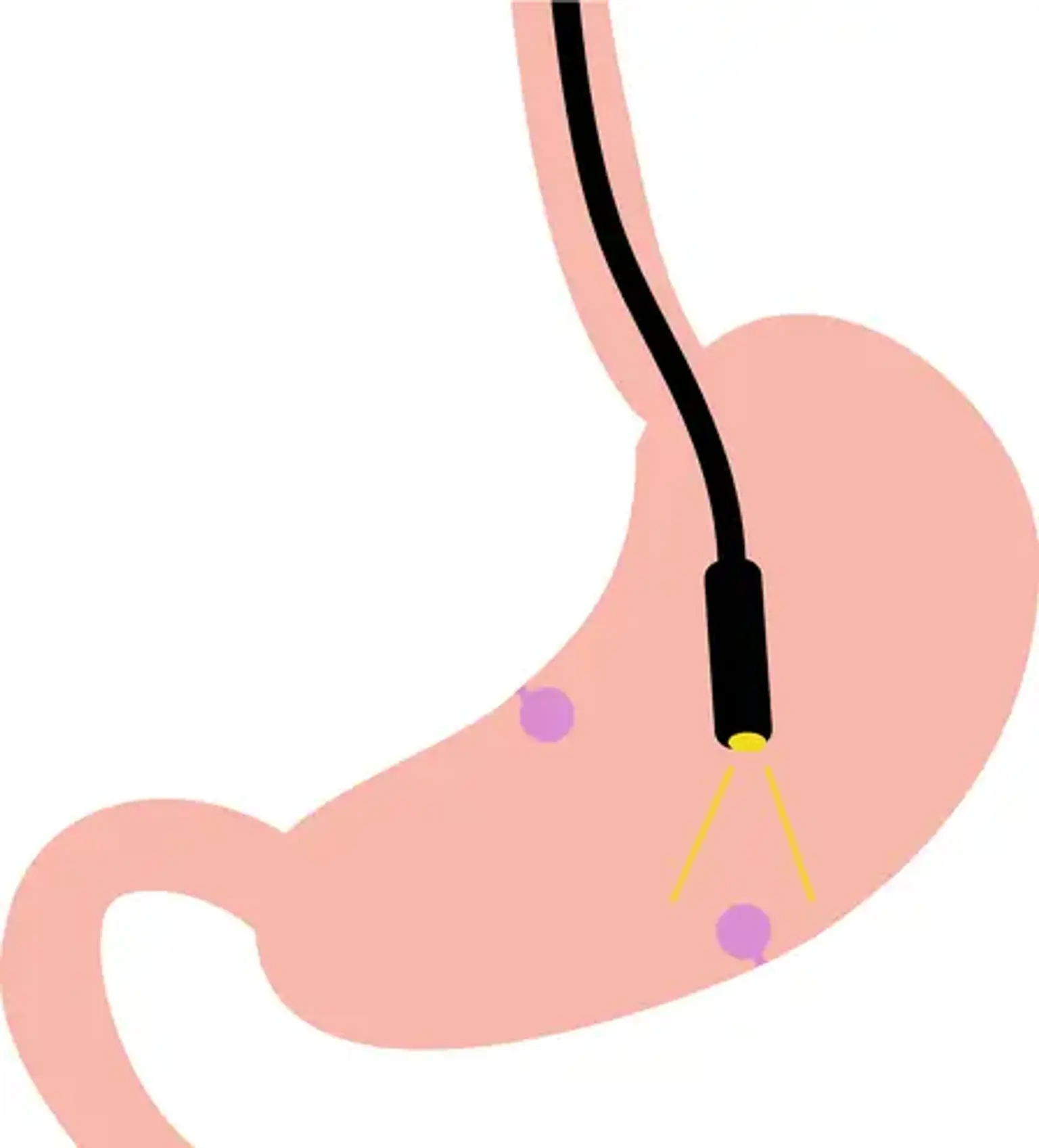 Endoscopic Submucosal Dissection (ESD)