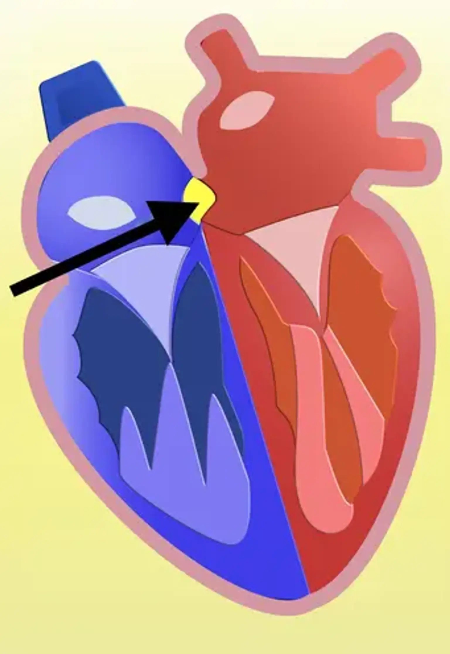 Comunicación interauricular (CIA)