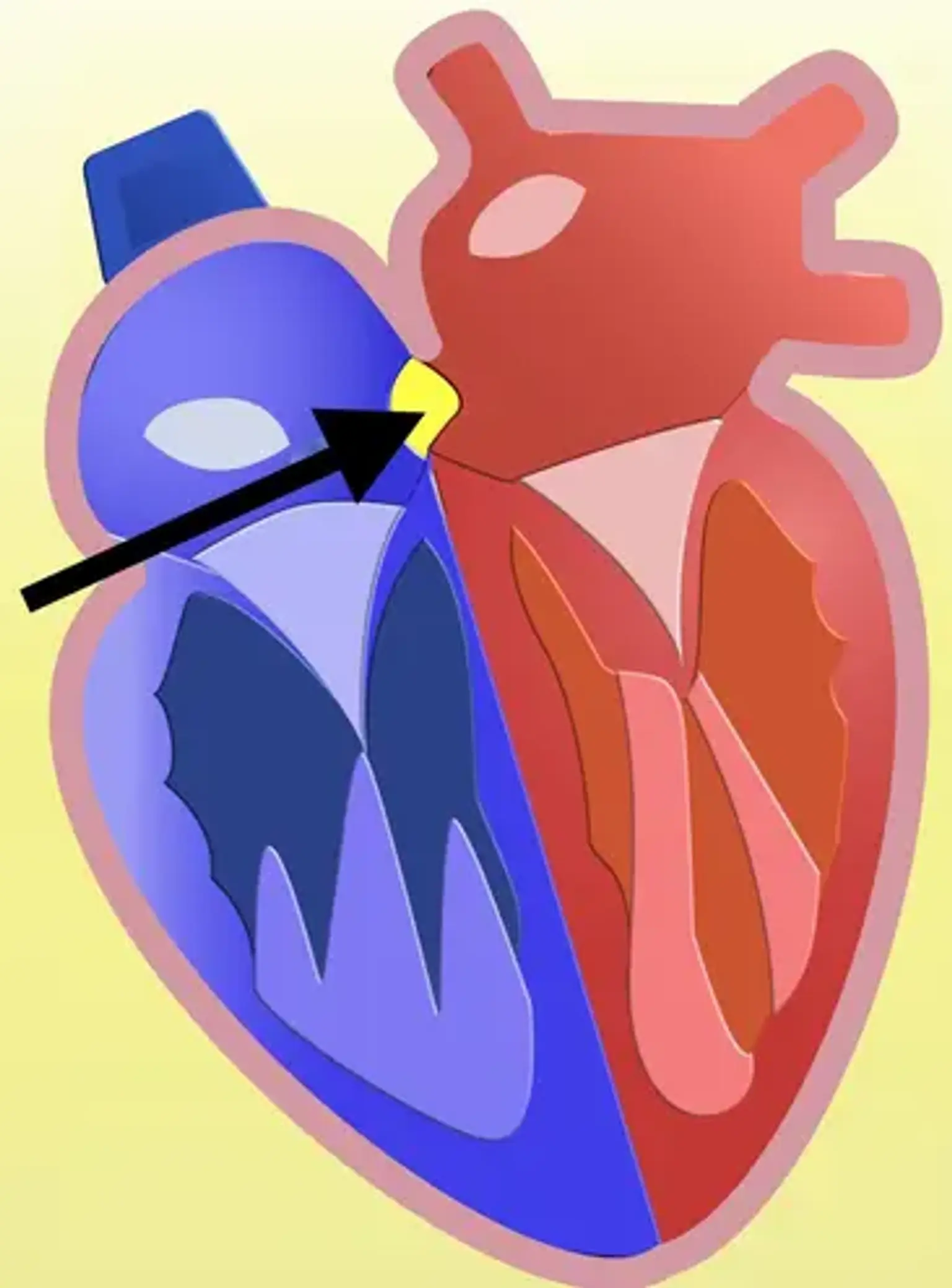 Defek Septum Atrium (ASD)