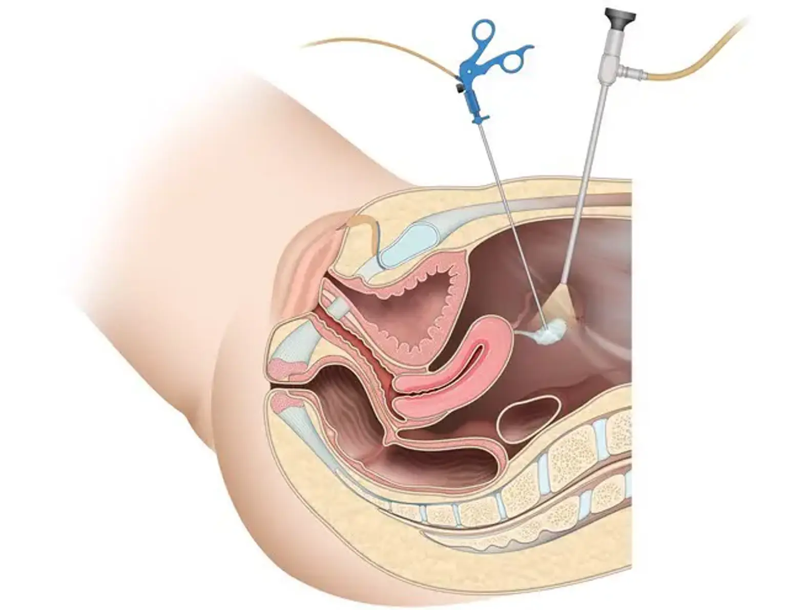 Gynecologic Laparoscopy