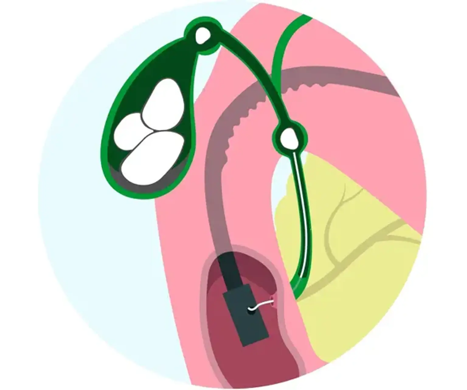 Endoscopic Choledochoduodenostomy