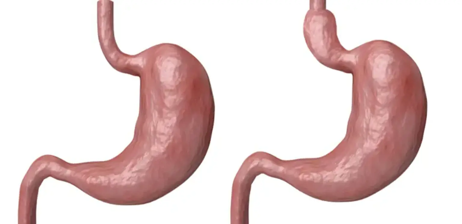 Gastrocele (Stomach Hernia)