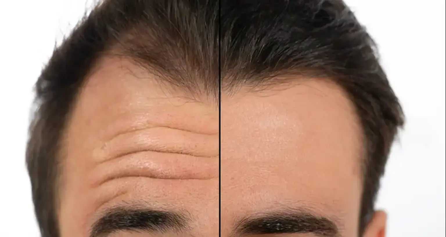 Forehead lifting