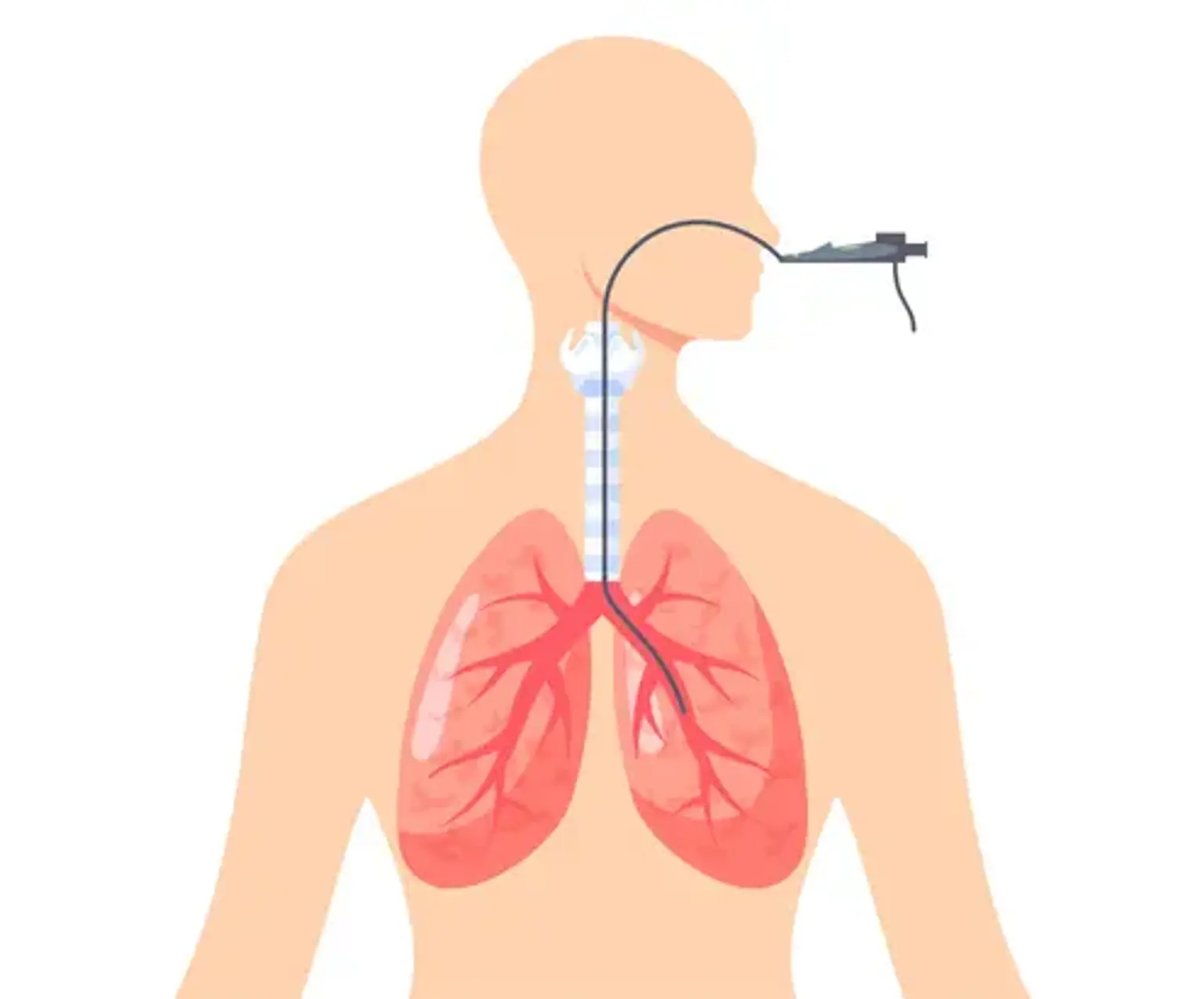 Pediatric flexible bronchoscopy