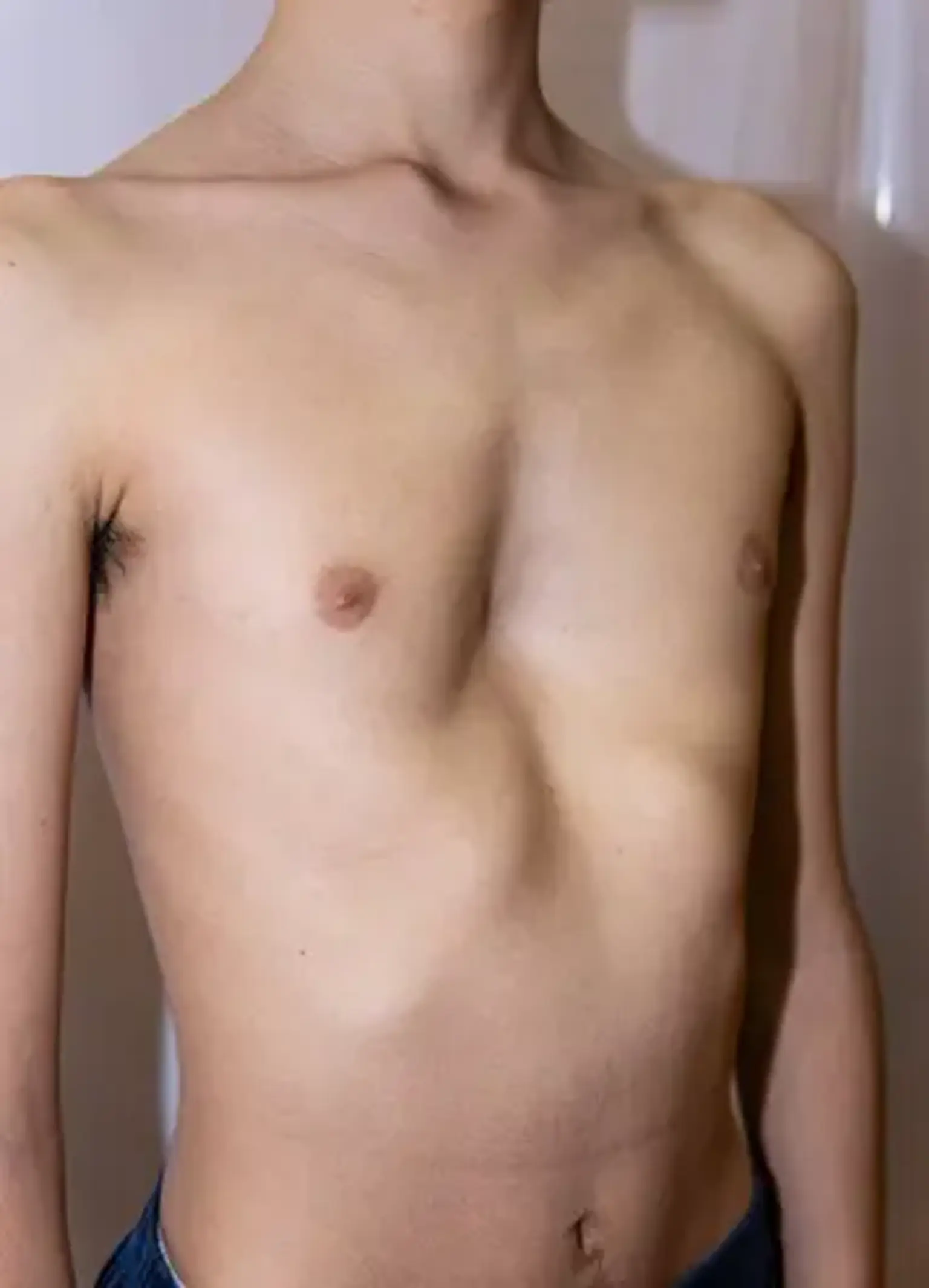 Funnel chest deformity