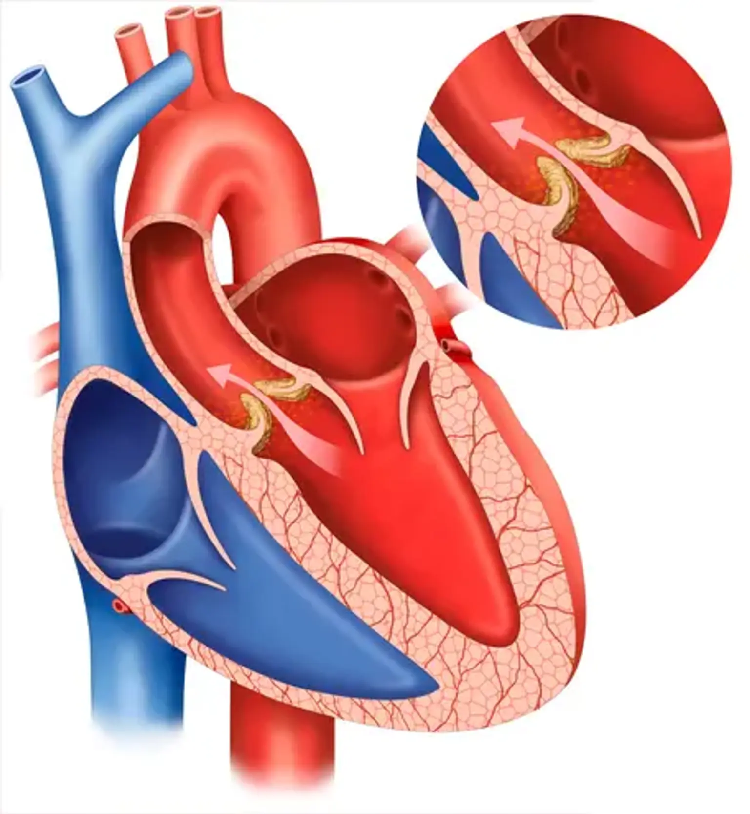 Aortic Regurgitation 