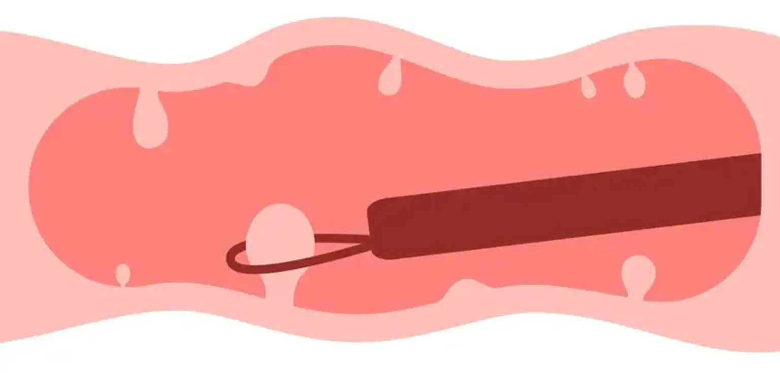 Cắt bỏ Polyp nội soi