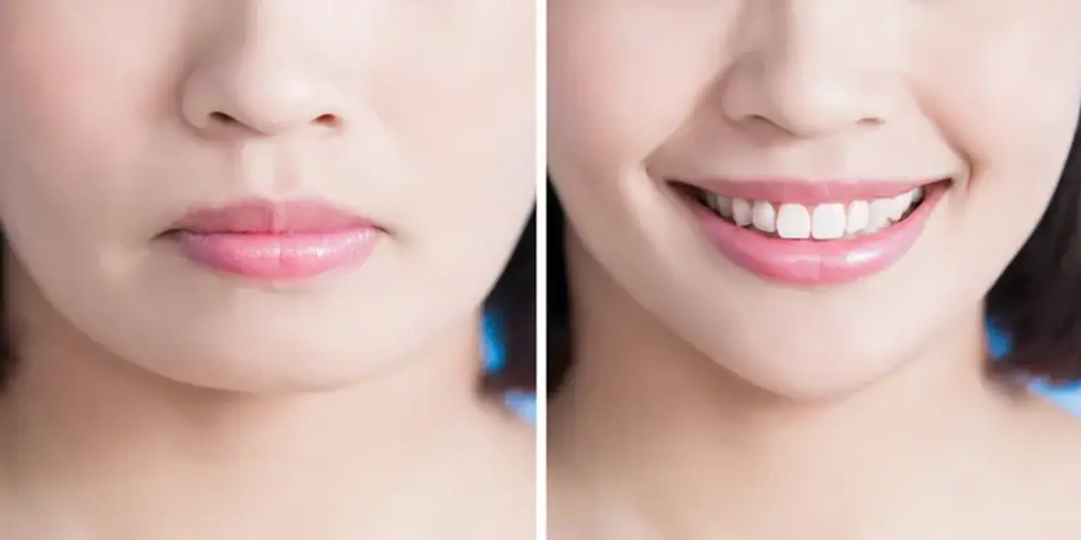 Reduksi Rahang Persegi