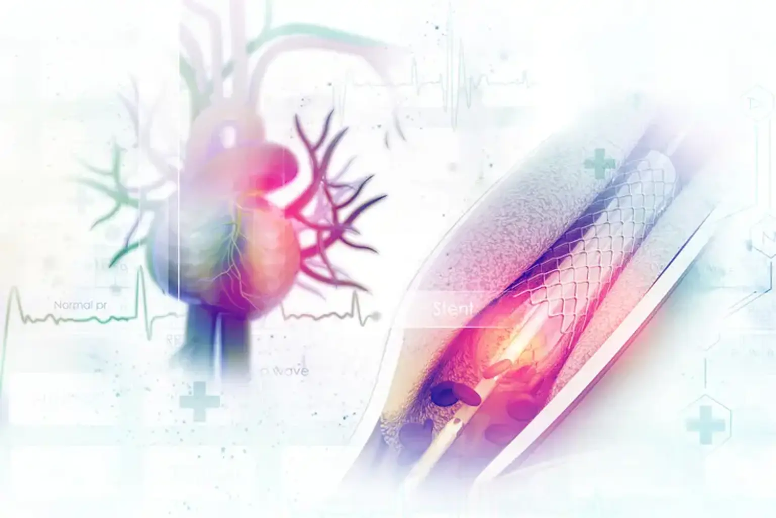 Rotational Atherectomy