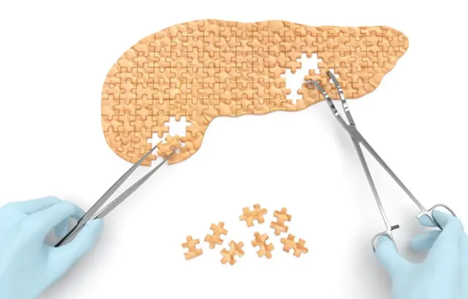 Pancreatic Cyst