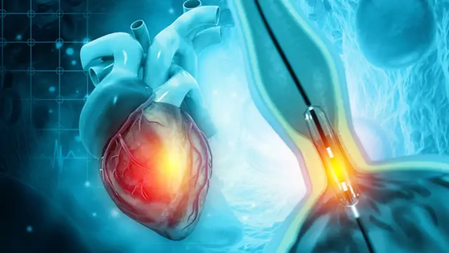 Coronary Angiography