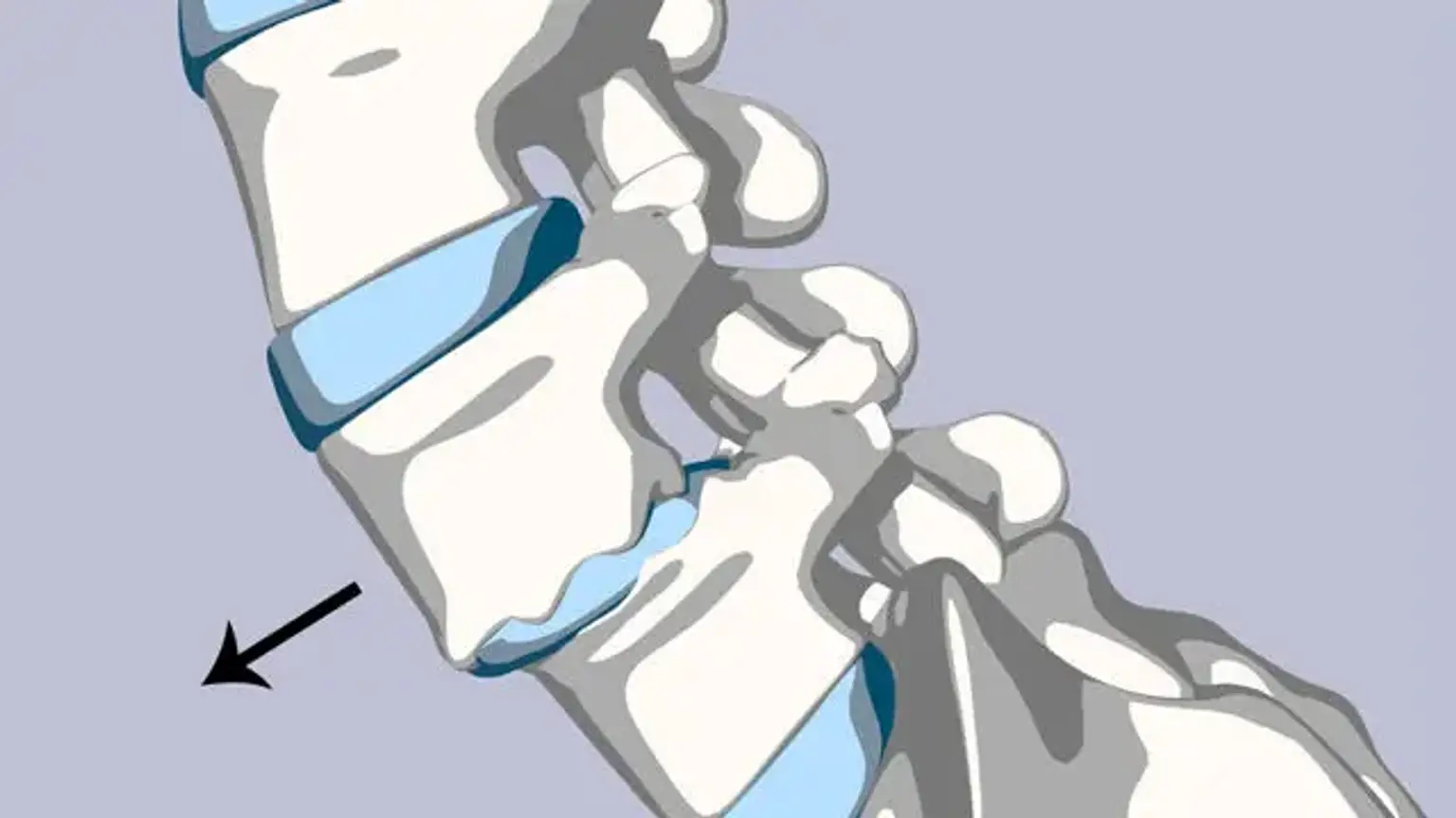 Spondylolisthesis