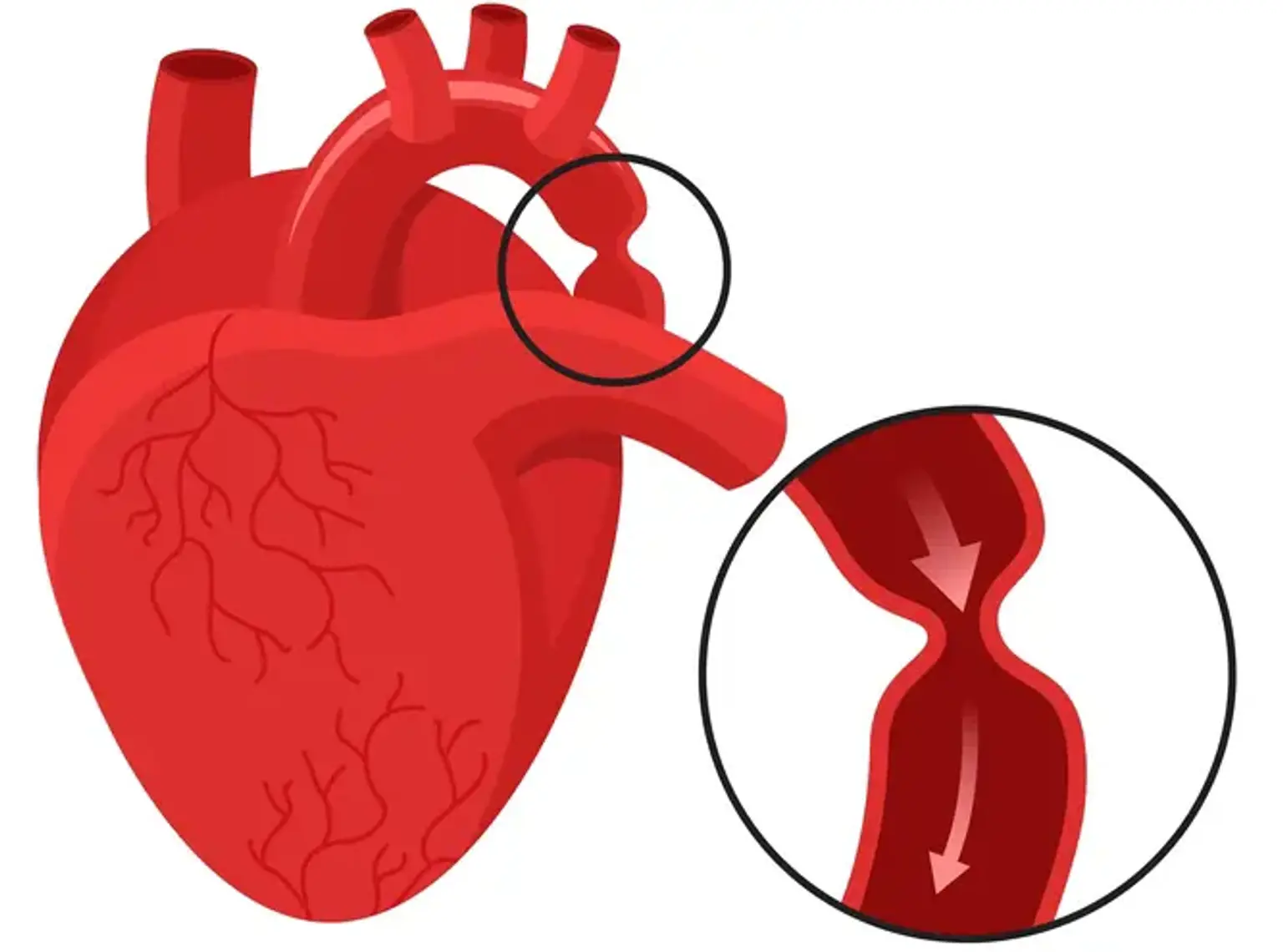 Stenting Of COA