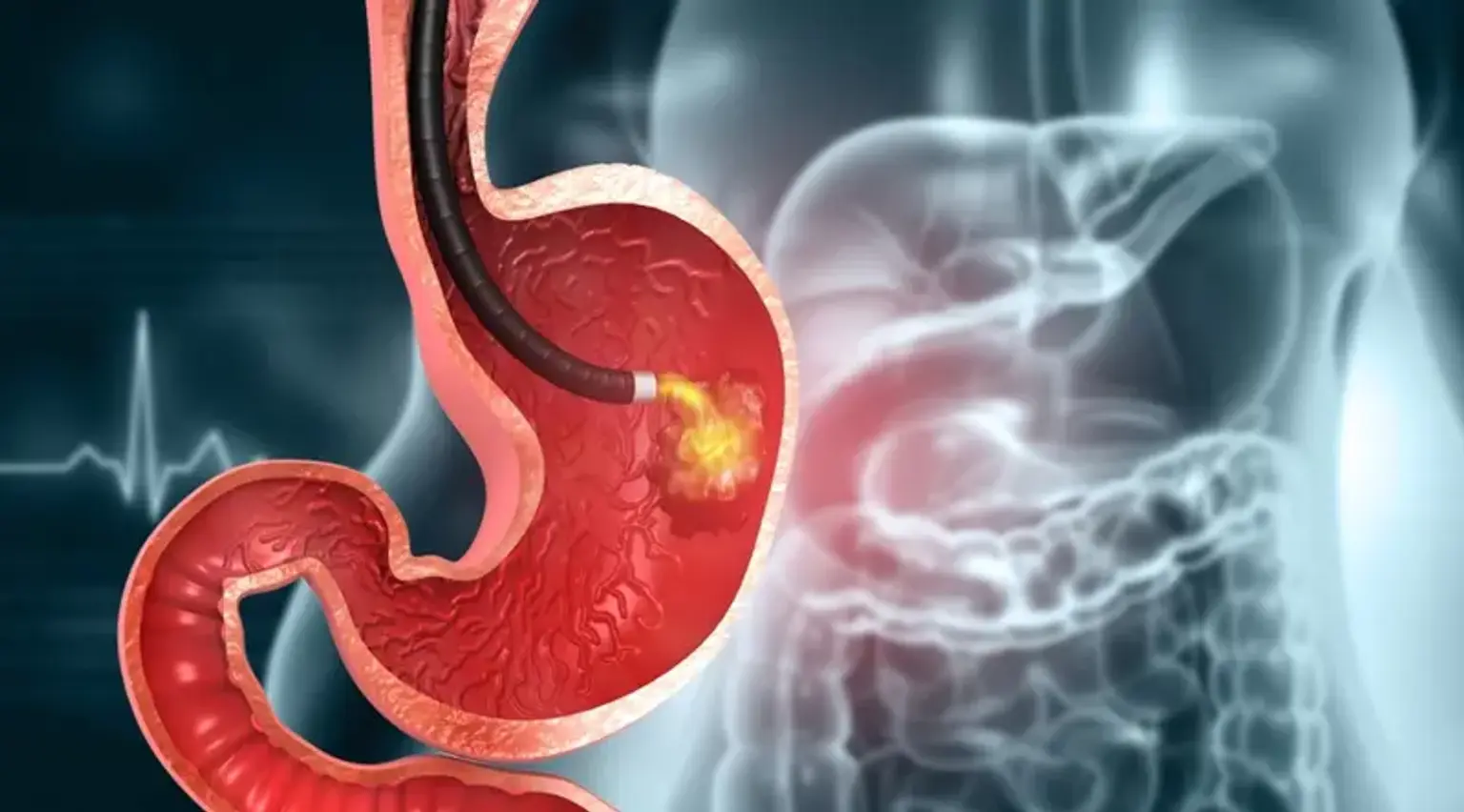 Submucosal tumor (SMT) 