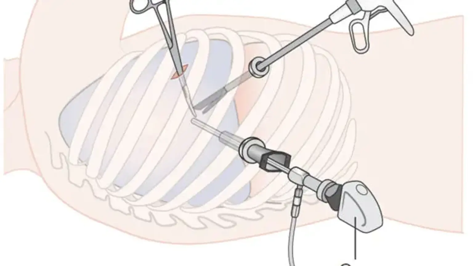 Video-assisted thoracoscopic surgery