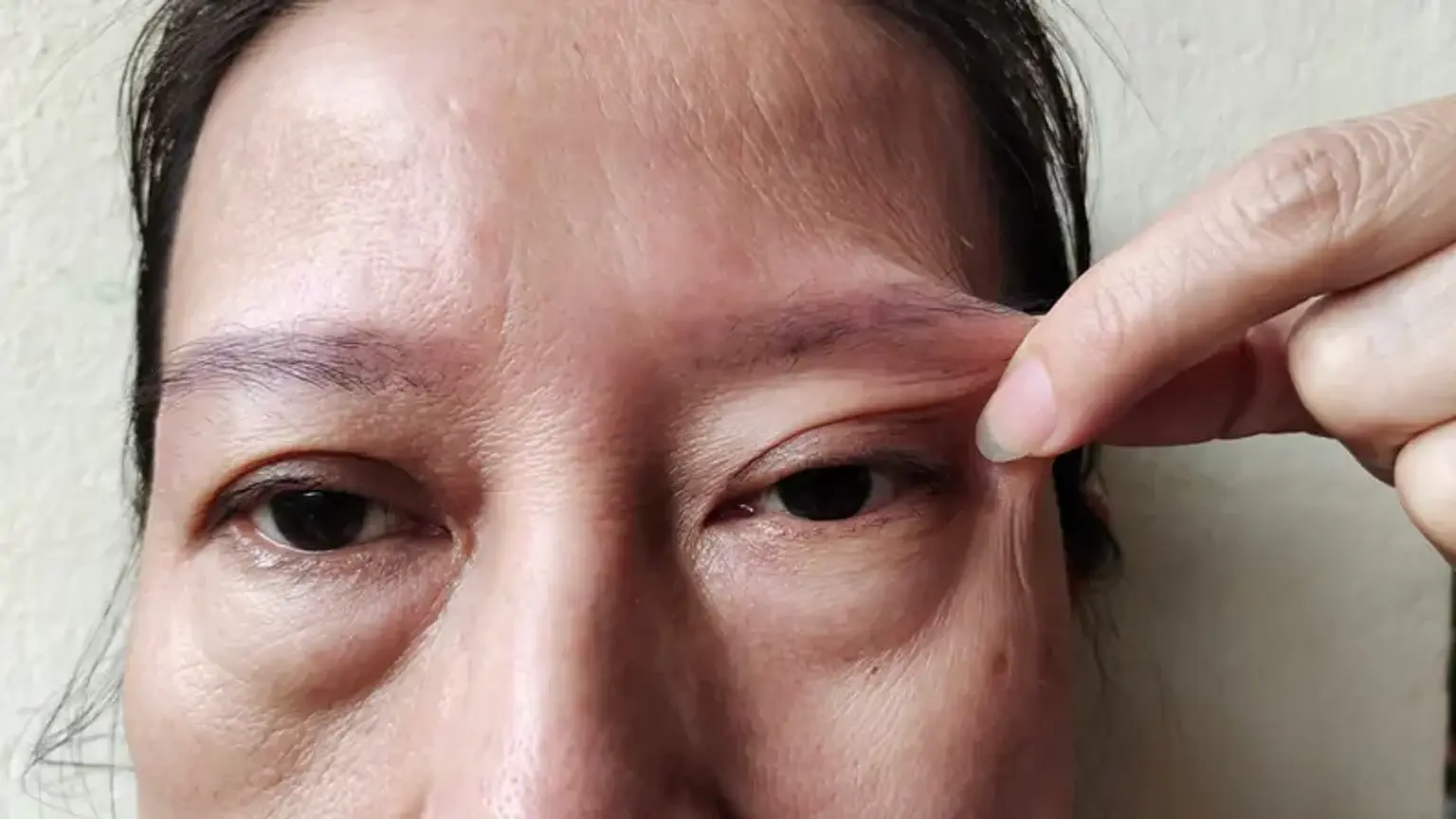 Ptosis Correction Cost by Countries