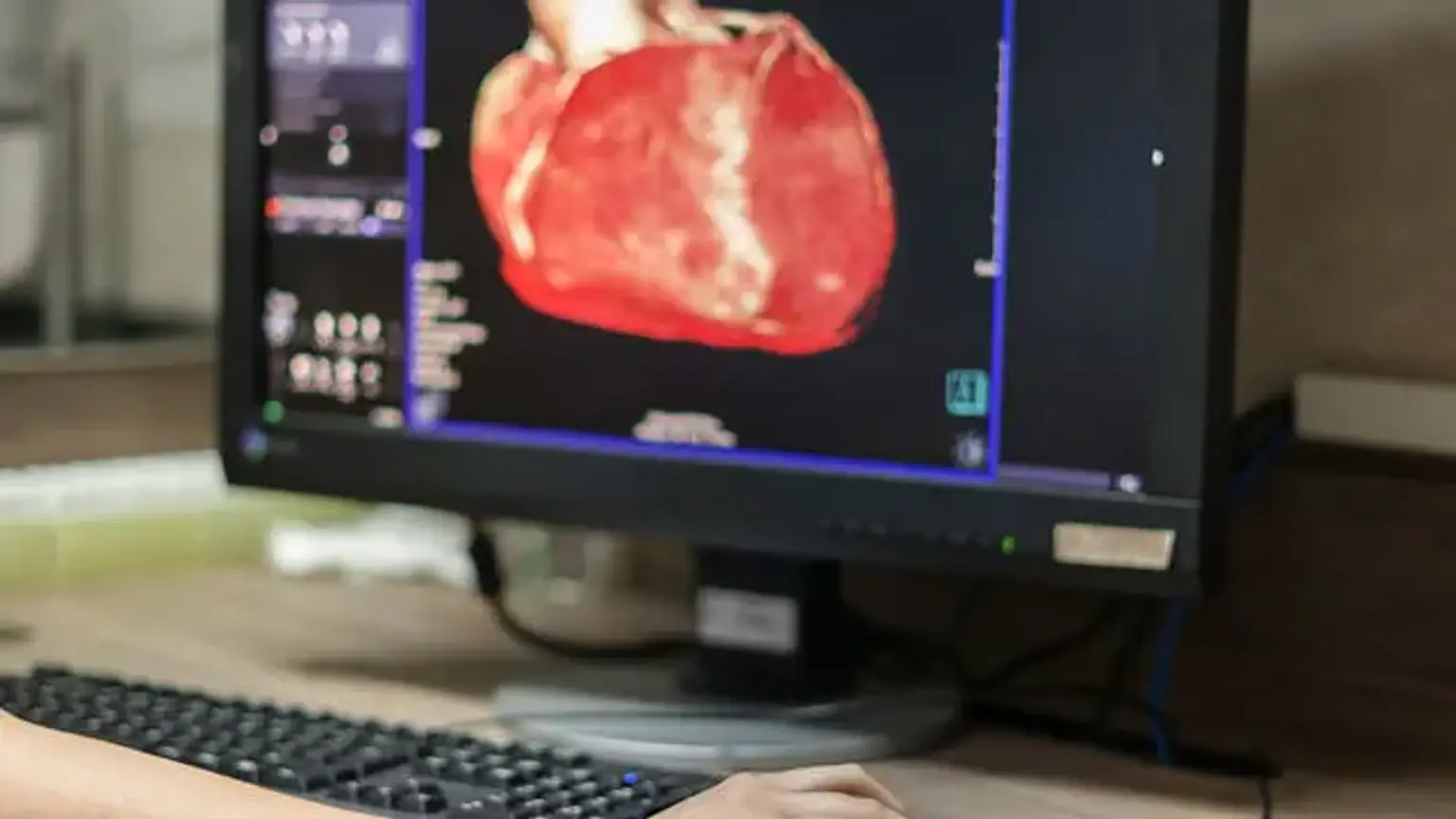 Coronary CT Angiography