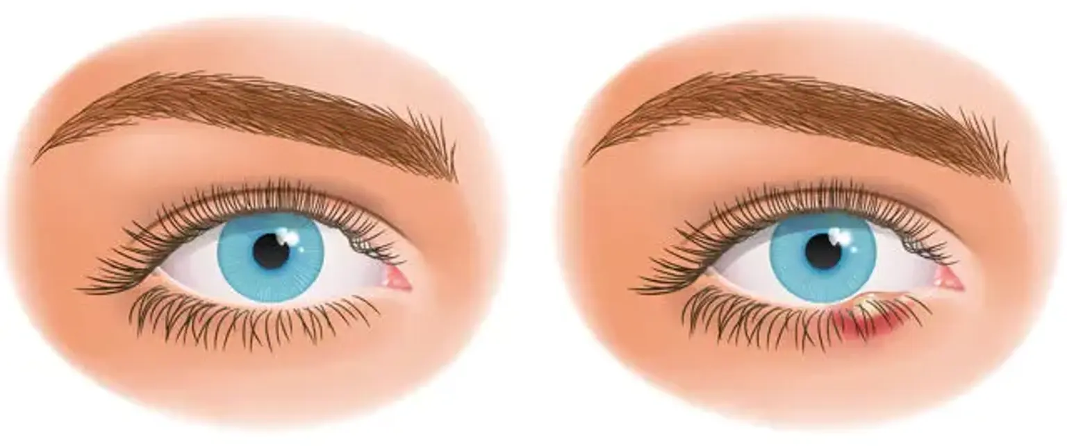 Stye in eyelid 