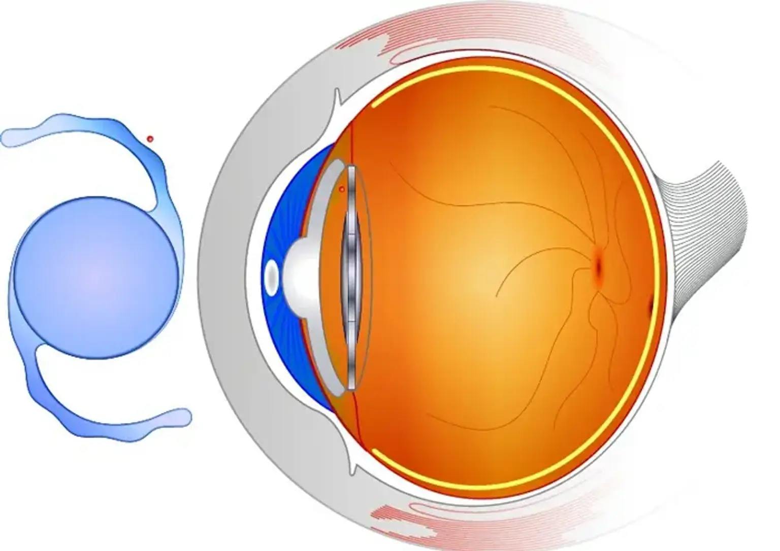 Phakic Intraocular Lens (PIOL) Implantation