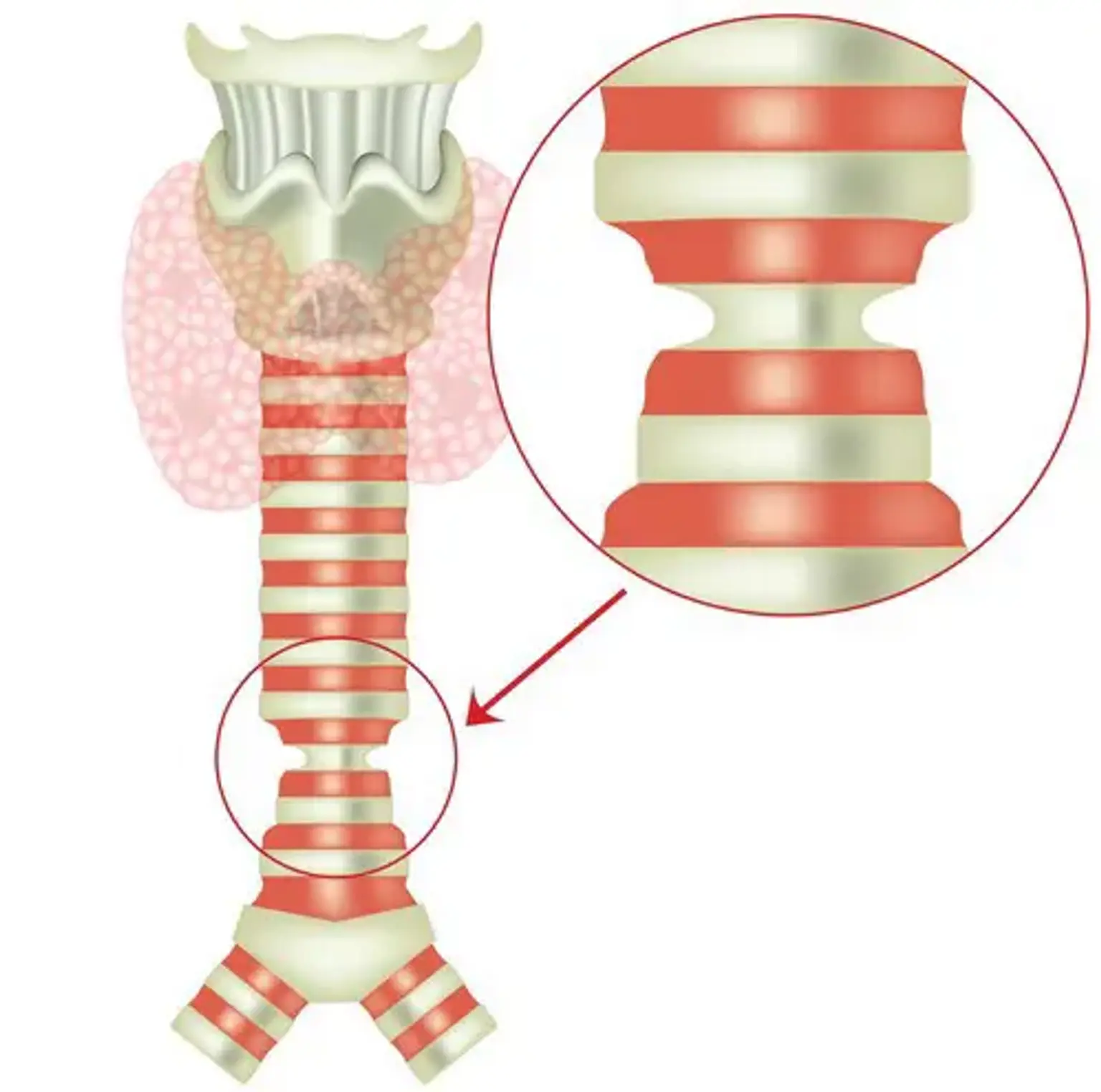 Congenital tracheal stenosis