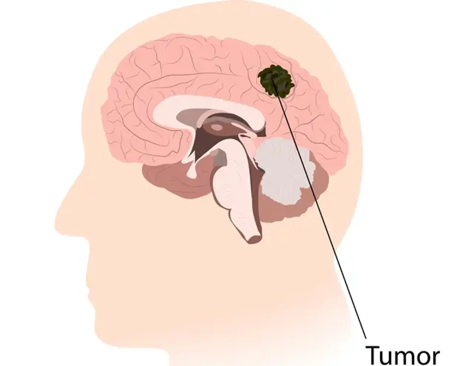 Astrocytoma