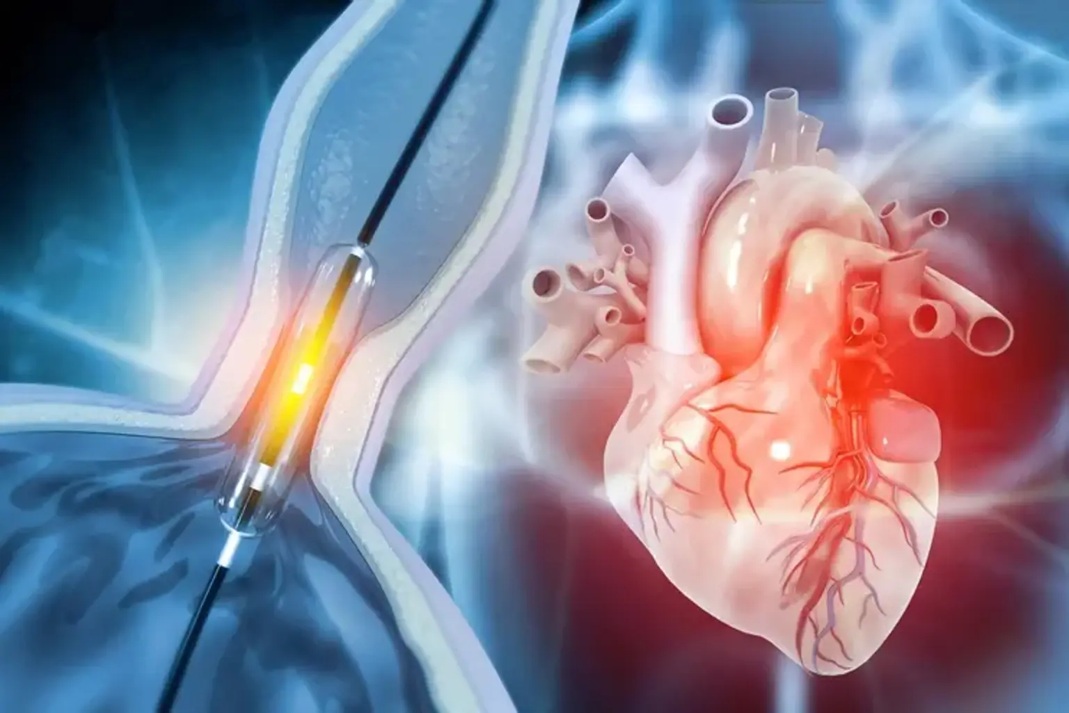 Complex Coronary Interventions