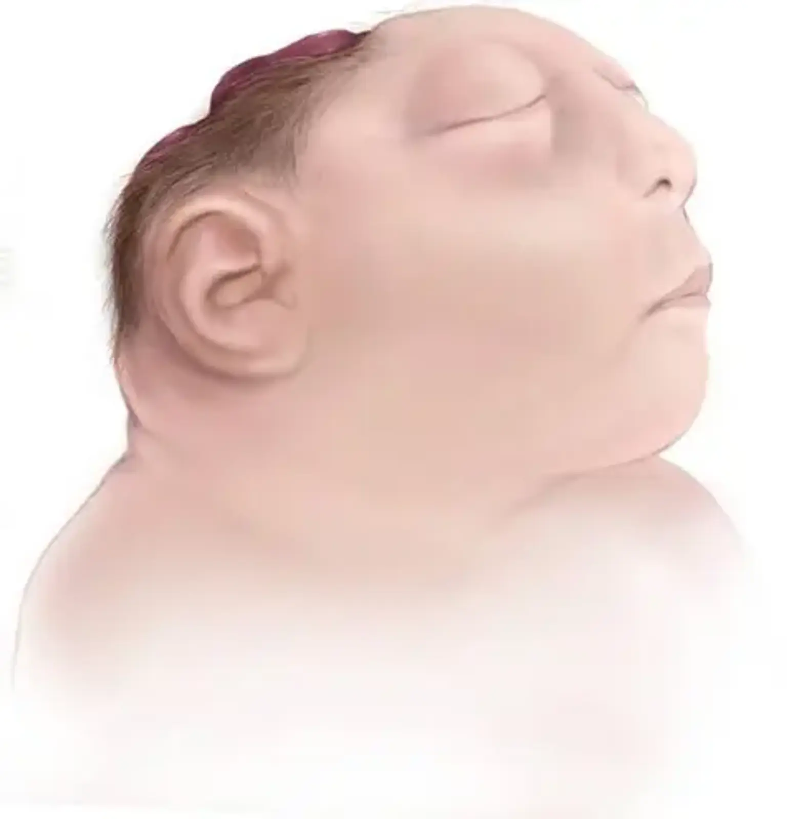 Anencephaly