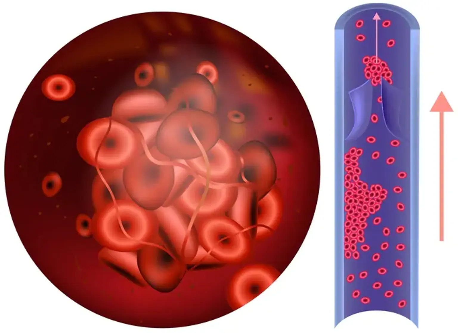 Antiphospholipid Syndrome