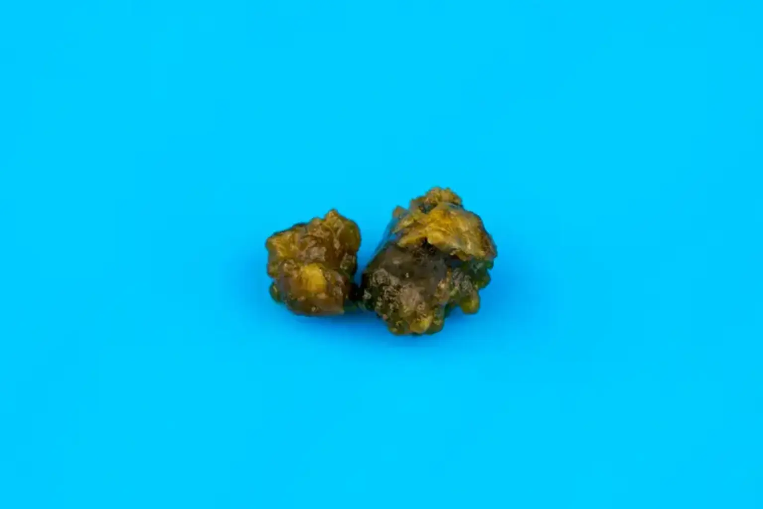 Mini Percutaneous Nephrolithotomy