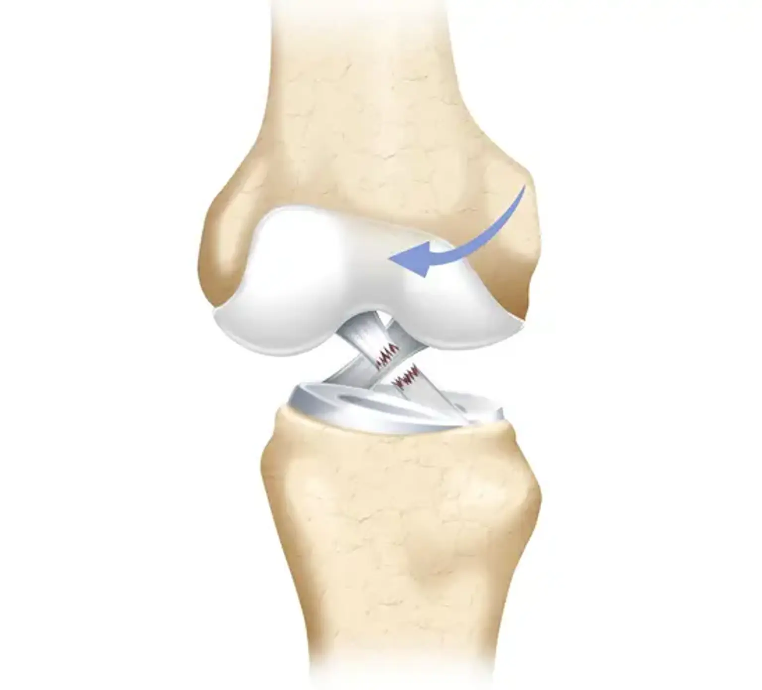 Lesiones del ligamento de la rodilla