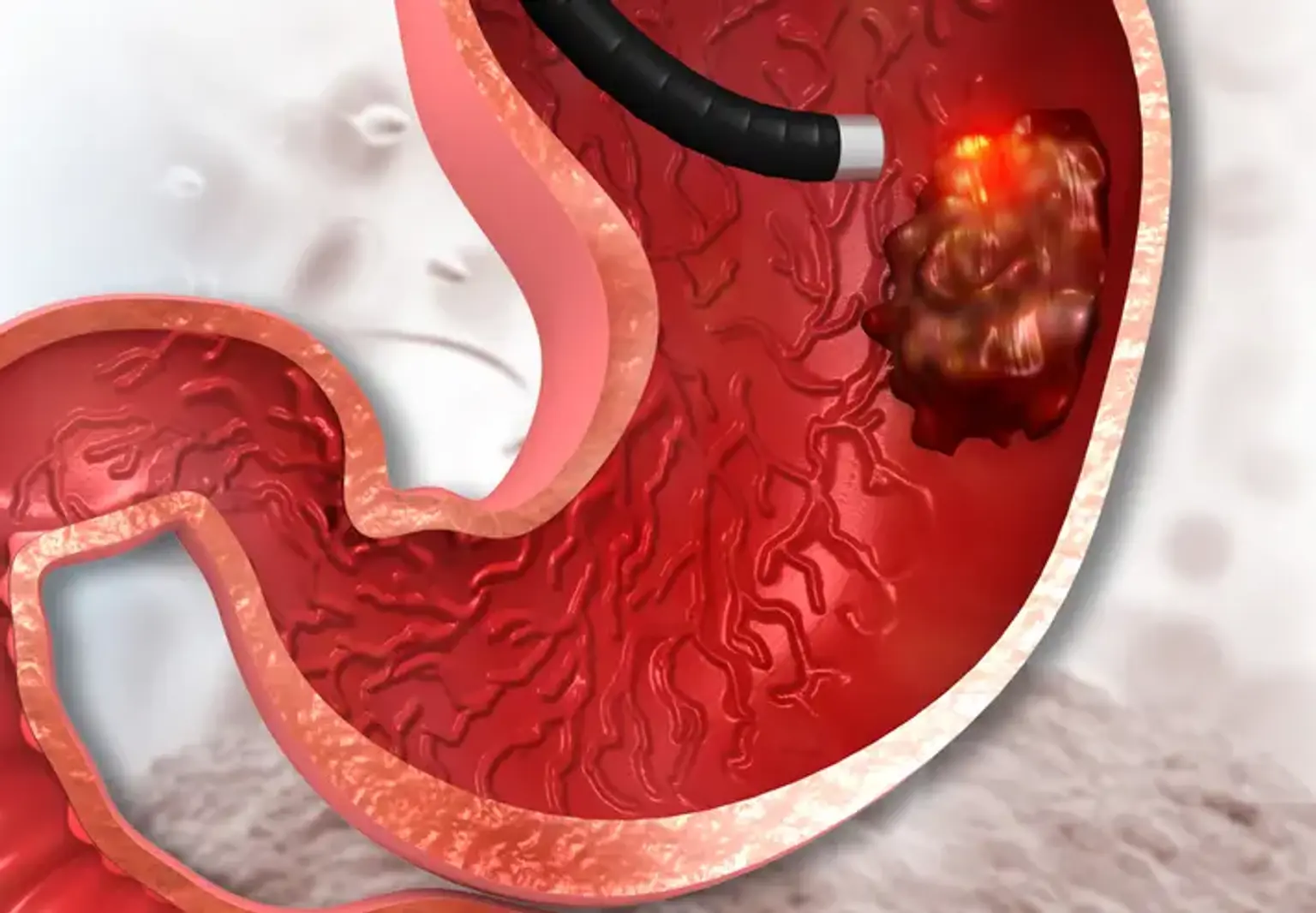 Endoscopic Mucosal Resection