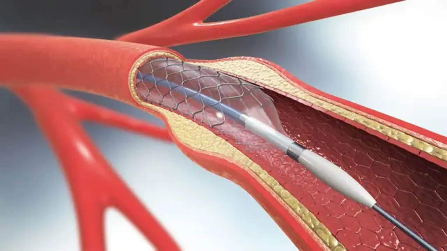 Carotid Artery Stenting