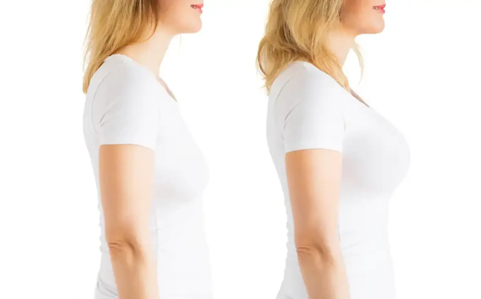 Combination Breast Augmentation