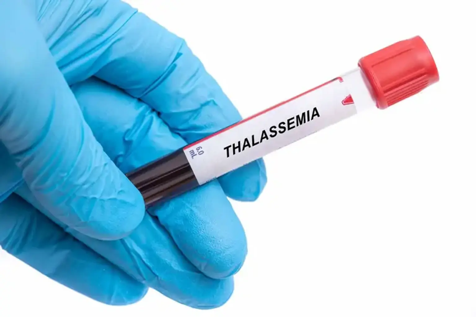 Thalassemia