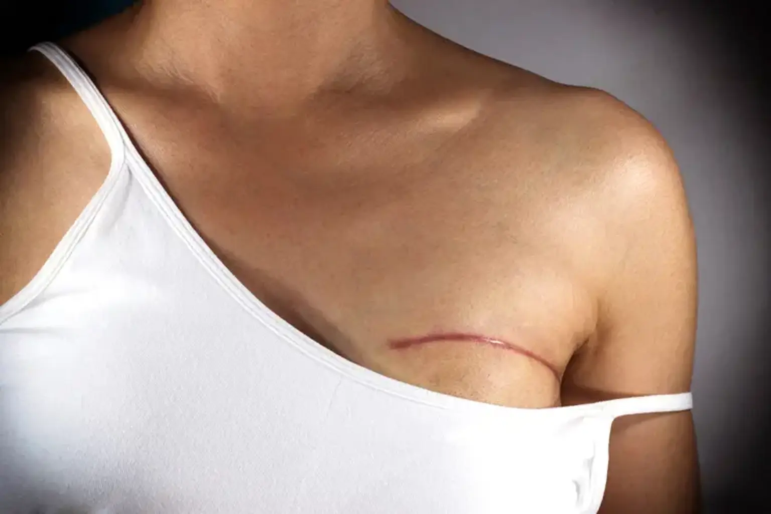 Mastectomy